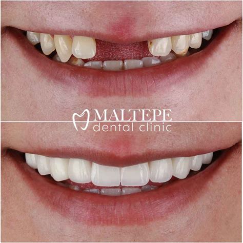 Dental Bridge Front Teeth Before And After