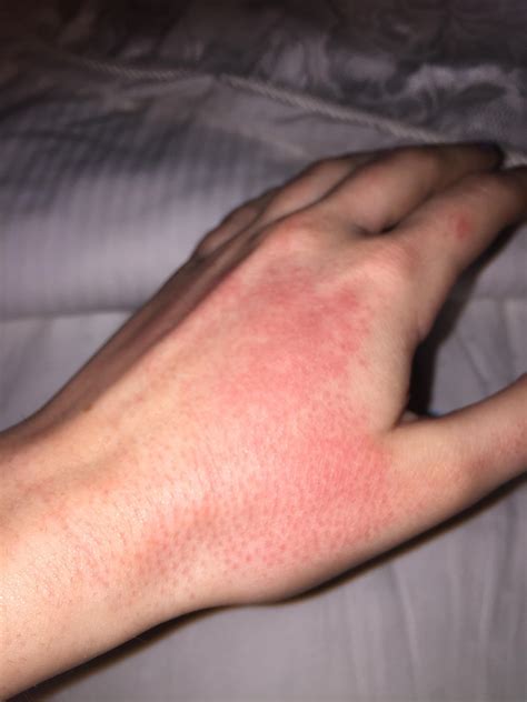 How To Get Rid Of Dry Skin Rash On Hands at Eva Harpur blog