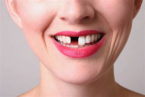 tooth loss     smile problem  negative
