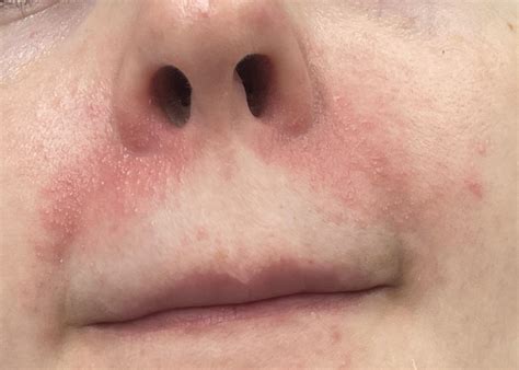 Dermatitis flare up : r/tretinoin