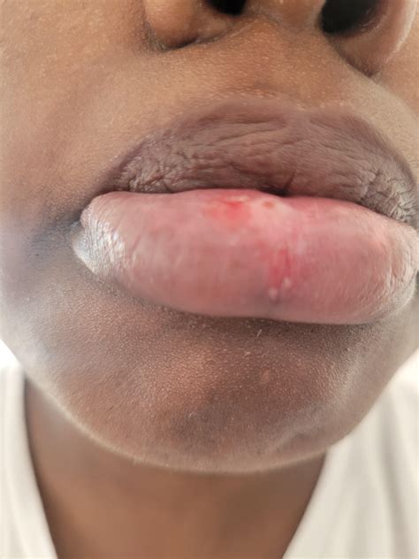 Little white lump. mucous cyst? | Scrolller