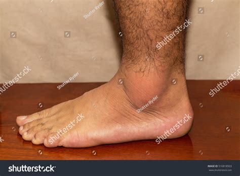 Painful Gout Inflammation On Ankle Joint Stock Photo 516818503
