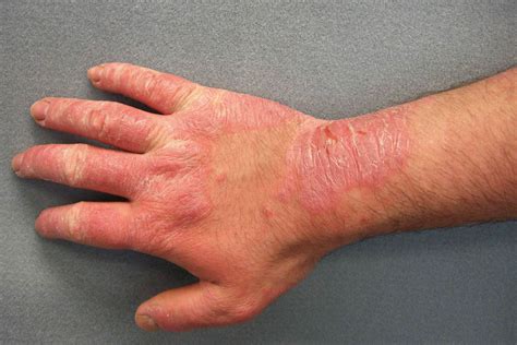 9 Common Causes of a Rash on Palms With Treatments