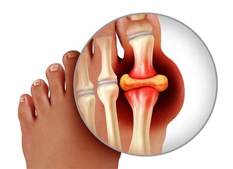 gout       health outcomes zoom pharmacy