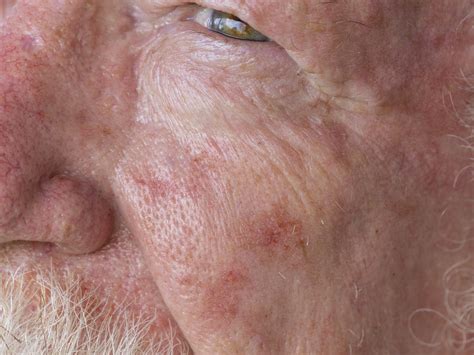 What Happens If Actinic Keratosis Is Left Untreated? – Balmonds