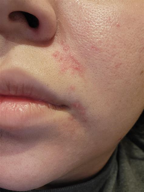 Stubborn red and bumpy blemishes. info in comments. : r/acne