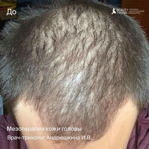 Мезотерапия лица: цены, отзывы, фото до и после безоперационного ...