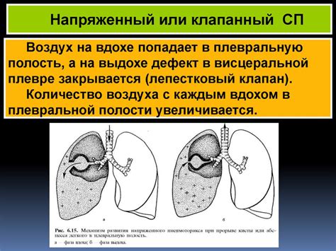 Осложнения туберкулеза - презентация онлайн