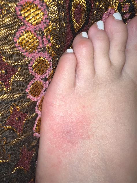 What bit me? In UK walking around house barefoot. Was a bite with blue