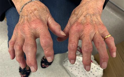 investigational   denosumab  erosive hand osteoarthritis