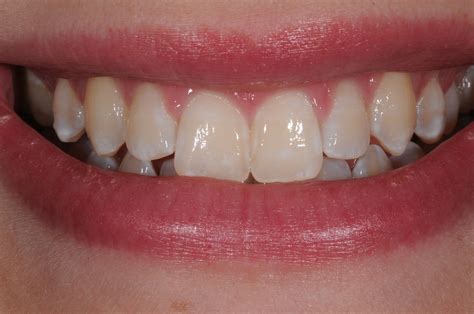 Teeth Treat: Fastest teeth whitening