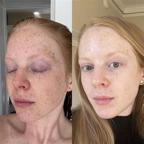 [Before & After] 2 months application of Vitamin C + gentle exfoliation ...