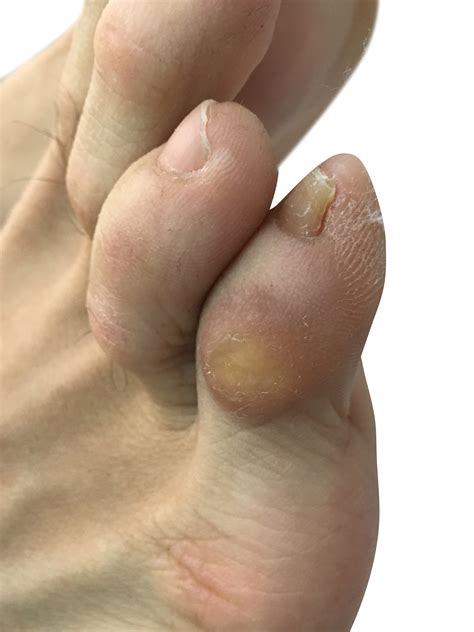 Corns of the feet and the different types | Dubai Podiatry Centre