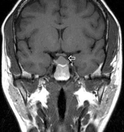 Brandy's CT Pathology Blog: Prolactinoma