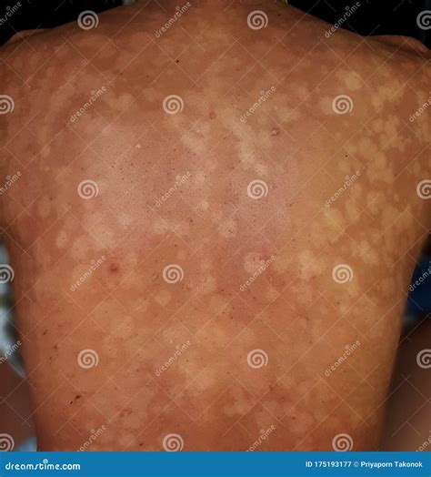 Tinea Versicolor Pitriasis Versicolor Infección Cutánea En La Espalda
