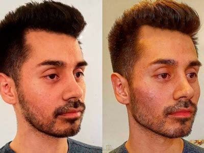 derma medical masculinisation virilization