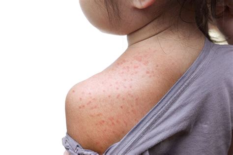 Discoid Eczema: 10 Symptoms Of Discoid Eczema