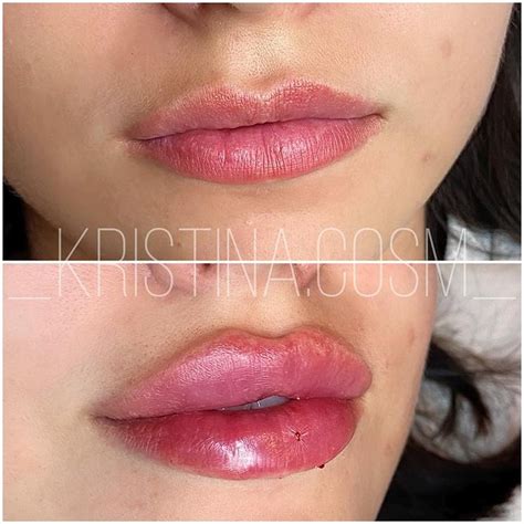 Pin on Lip augmentation with hyaluronic acid ( ГУБЫ)