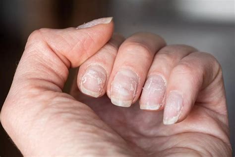 Unha Descamando - Unhas descamando: causas e tratamentos eficazes