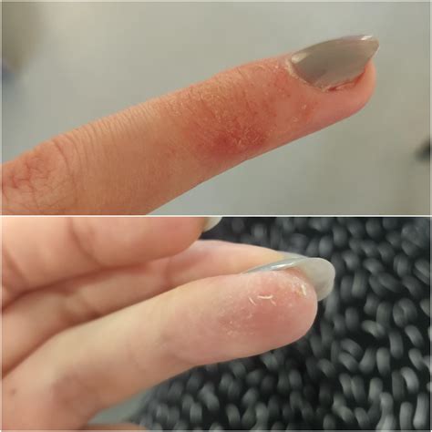 Sometimes there are tiny blisters that itch and liquid comes out of