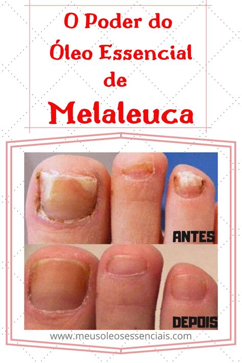 Oleo De Melaleuca Antes E Depois