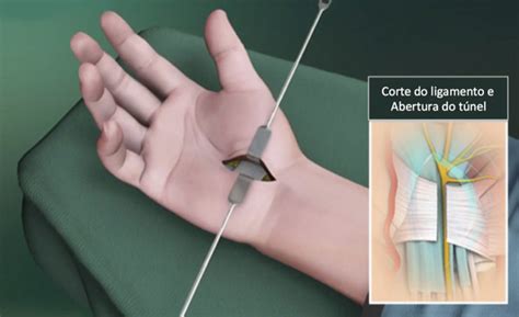 Como É Feita A Cirurgia Do Túnel Do Carpo - Preciso operar o túnel do carpo, e agora? Cirurgia convencional ou ...