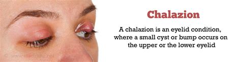 Chalazion (Eyelid Condition) - Causes, Symptoms, Signs, Diagnosis ...