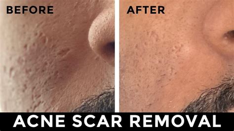 Acne Scar Removal: Laser, Fillers, Subcision, & RF Microneedling - YouTube