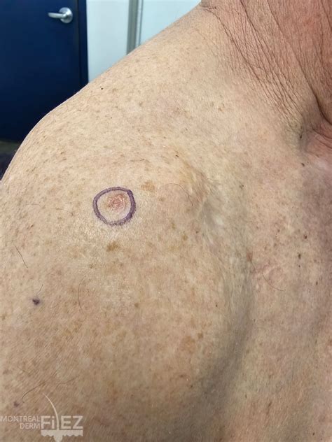 Actinic Keratosis, Basal Cell Carcinoma, and Squamous Cell Carcinoma