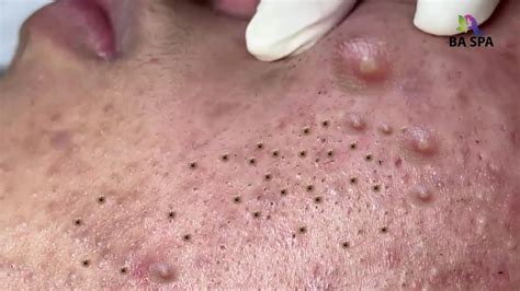 Popping huge blackheads and Pimple Popping - Best Pimple Popping Videos
