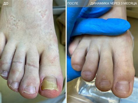 PACT-MED — цена фотодинамической терапии для лечения грибка ногтей в ...
