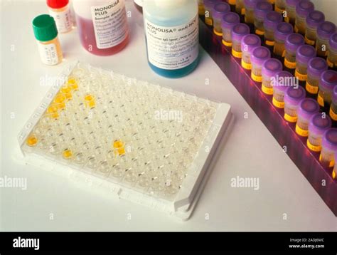 Hepatitis C test. Sample vials of human blood serum after tests for ...
