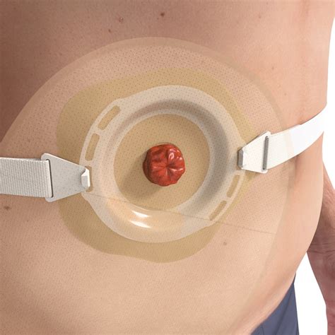 stoma leakage    ostomy bag leak  braun