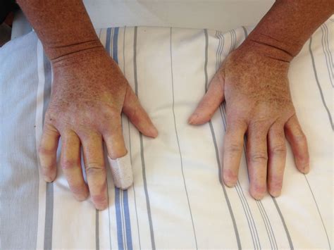 Crest Syndrome