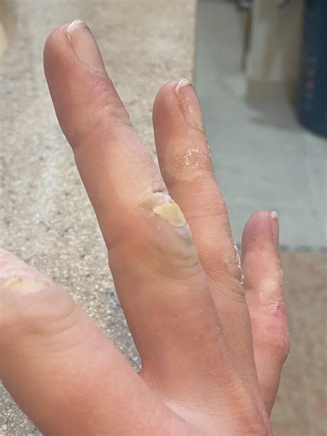 Hands feet face & warts , face &wart! Haaaaands feeeet face & warts