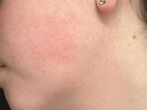 red splotch rskincareaddiction