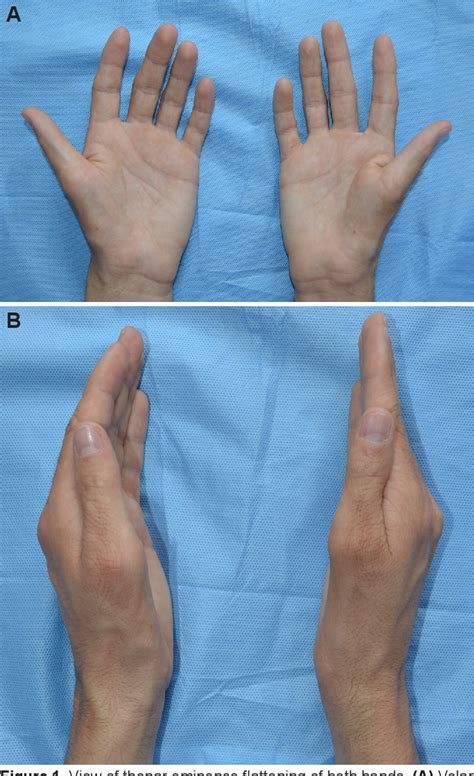 Abductor Pollicis Brevis Muscle - Anatomy of Hand / The csp was ...