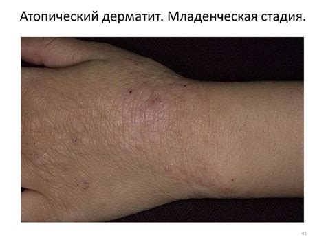 Зудящие дерматозы у детей. Почесуха. Атопический дерматит. Осложнения ...