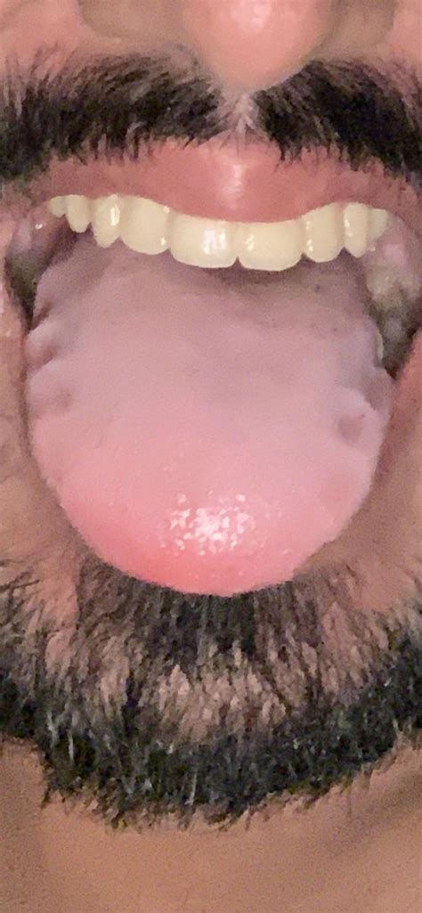 What are these grooves on my tongue : r/askdentists