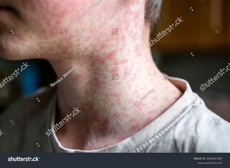measles viral disease human skin covered stock photo