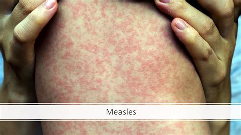 Measles - Emdoc Health