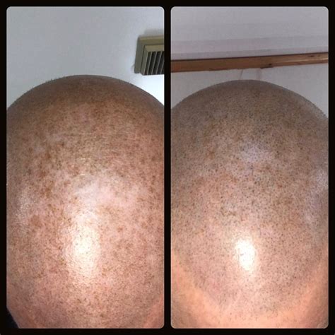 Scalp micro-pigmentation - Essjay Permanent Cosmetics