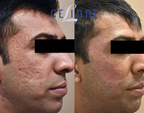 Best Acne Scar Treatment