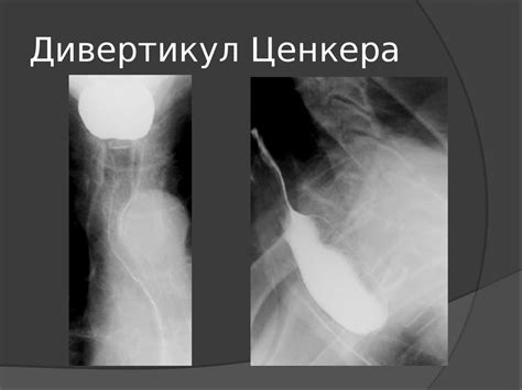 Заболевания пищевода. Смещения пищевода. Дивертикулы. Инородные тела ...