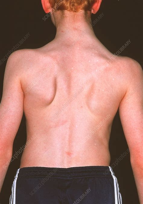 Soto's syndrome - Stock Image - M260/0211 - Science Photo Library