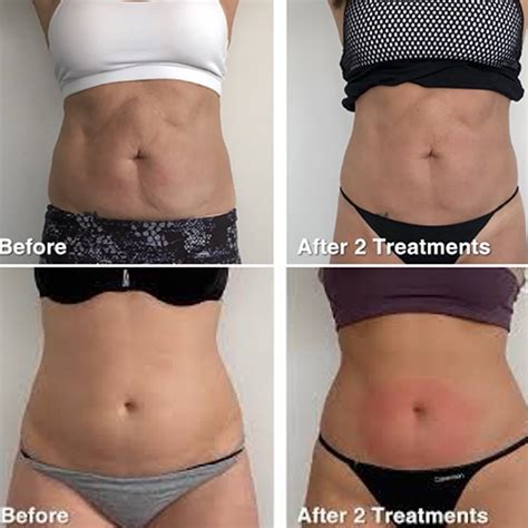 Adore Tummy Tuck (Scarless & Non Surgical) - BOdy Contouring - Adore ...