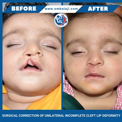 Best 13 Surgical correction of unilateral incomplete cleft lip