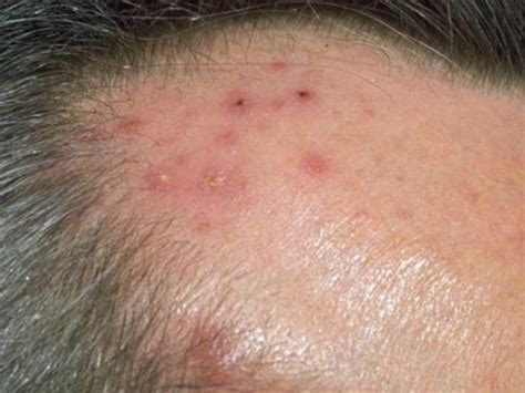 Global Skin Path Atlas | Diagnosis Detail