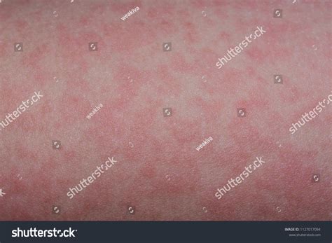 Rash Fifth Disease On Child Stock Photo 1127017094 | Shutterstock