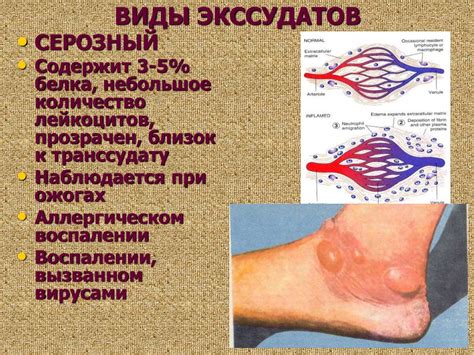 Воспаление. Причины воспаления - презентация онлайн